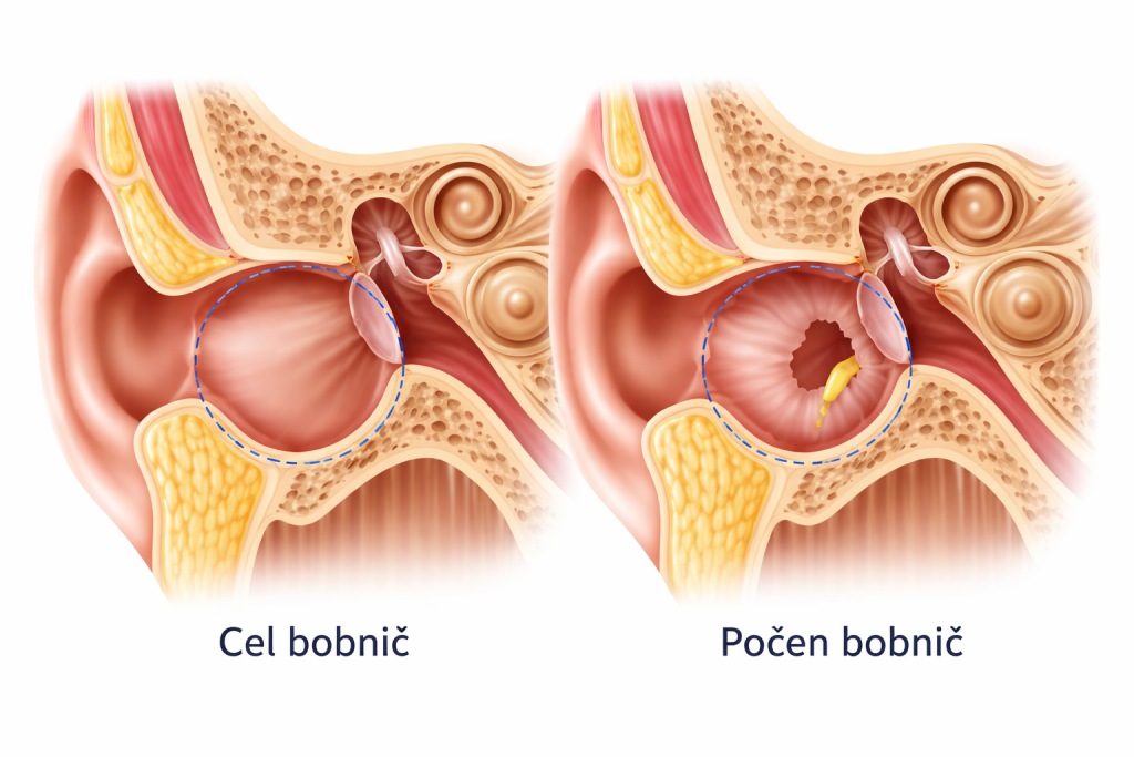Perforacija ali počen bobnič - cel bobnič - počen bobnič