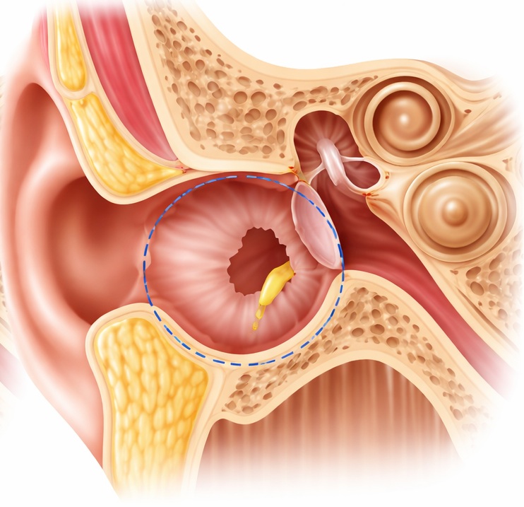 Perforacija - počen bobnič