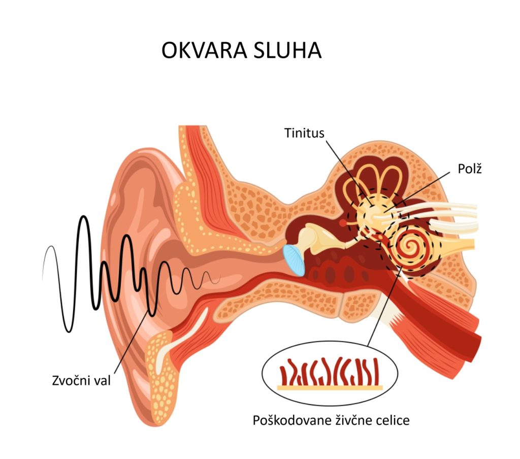 Okvara sluha - otoskleroza
